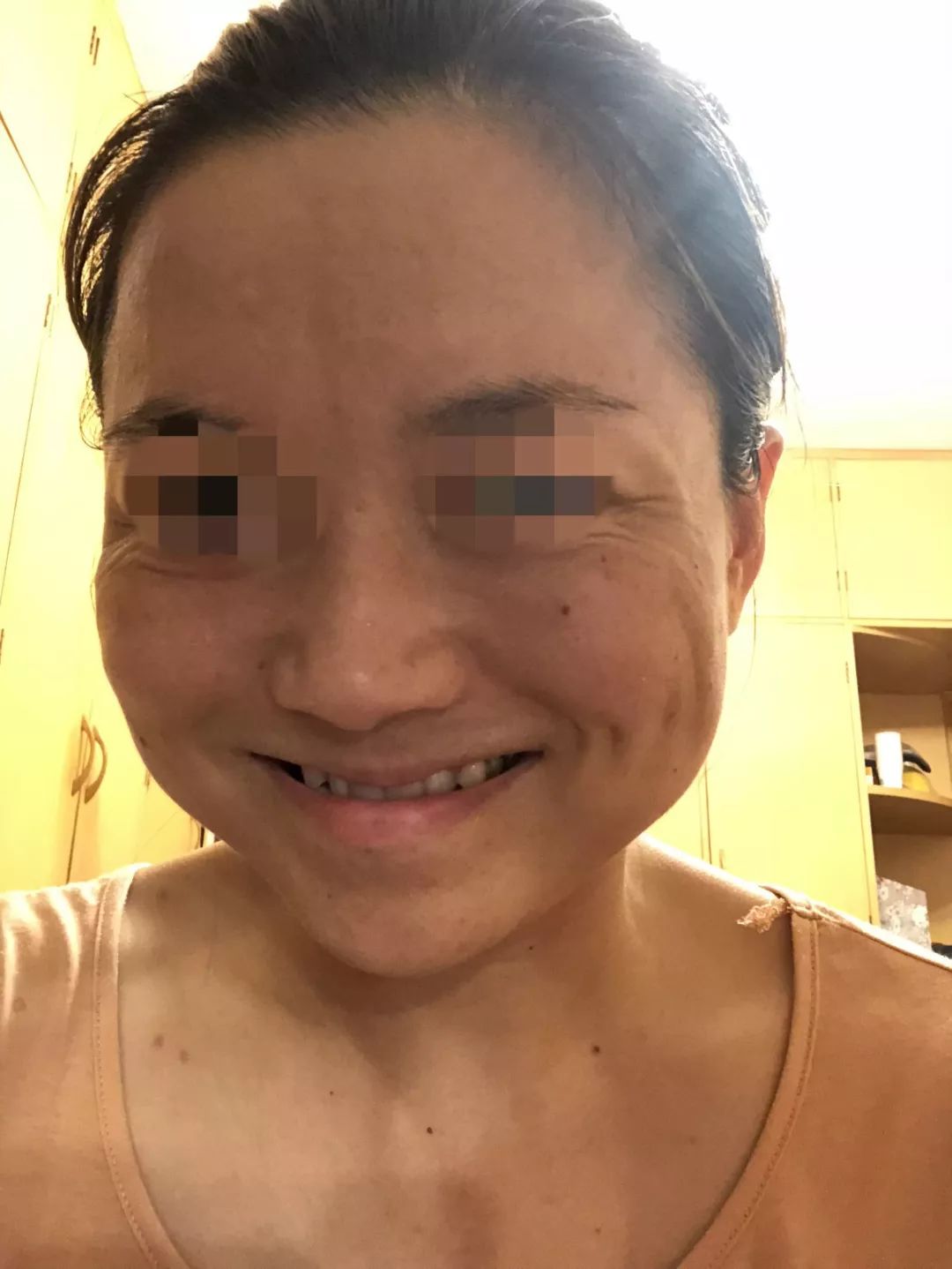 玫瑰医疗美容医院瘦脸针打垮女子曾经美丽那张脸